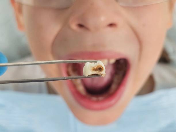 Best Emergency Dentist for Lost Fillings or Crowns in Burgettstown, PA